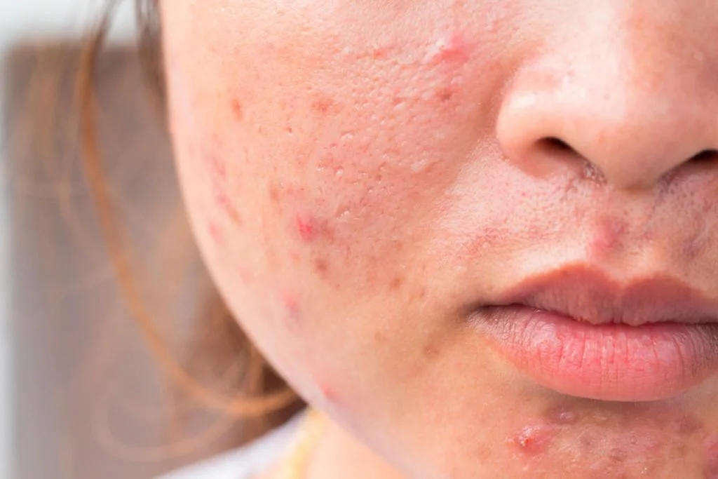 Is Acne an Essential Fatty Acid Deficiency?