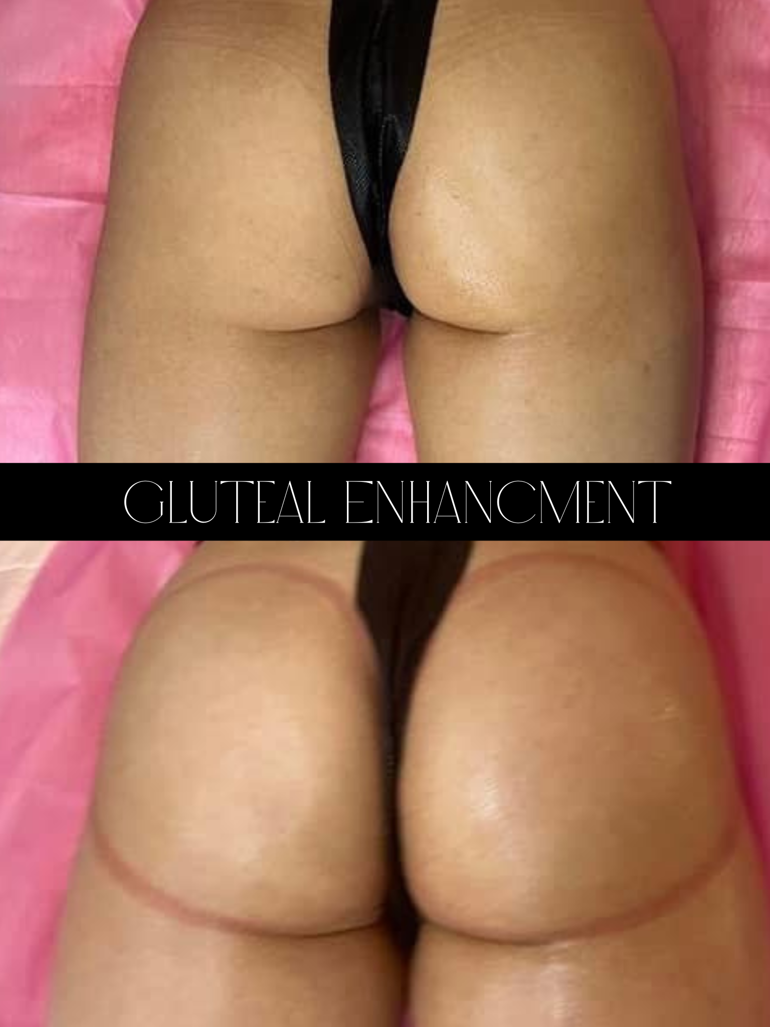 Close-up of woman's buttocks with a thong, on a pink surface, with the words "Gluteal Enhancement" written at the bottom.