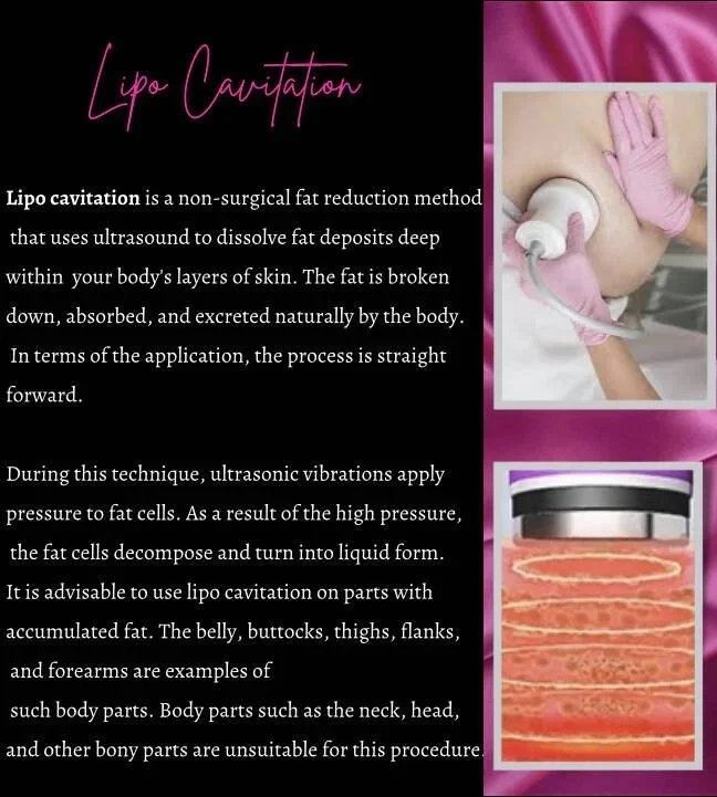 An informational graphic about lipo cavitation, showing a close-up of a medical procedure with a gloved hand holding a device on a person's abdomen, and an image of cross-sectioned fat cells. The text explains the non-surgical fat reduction method, how it works with ultrasound, and recommended treatment areas.