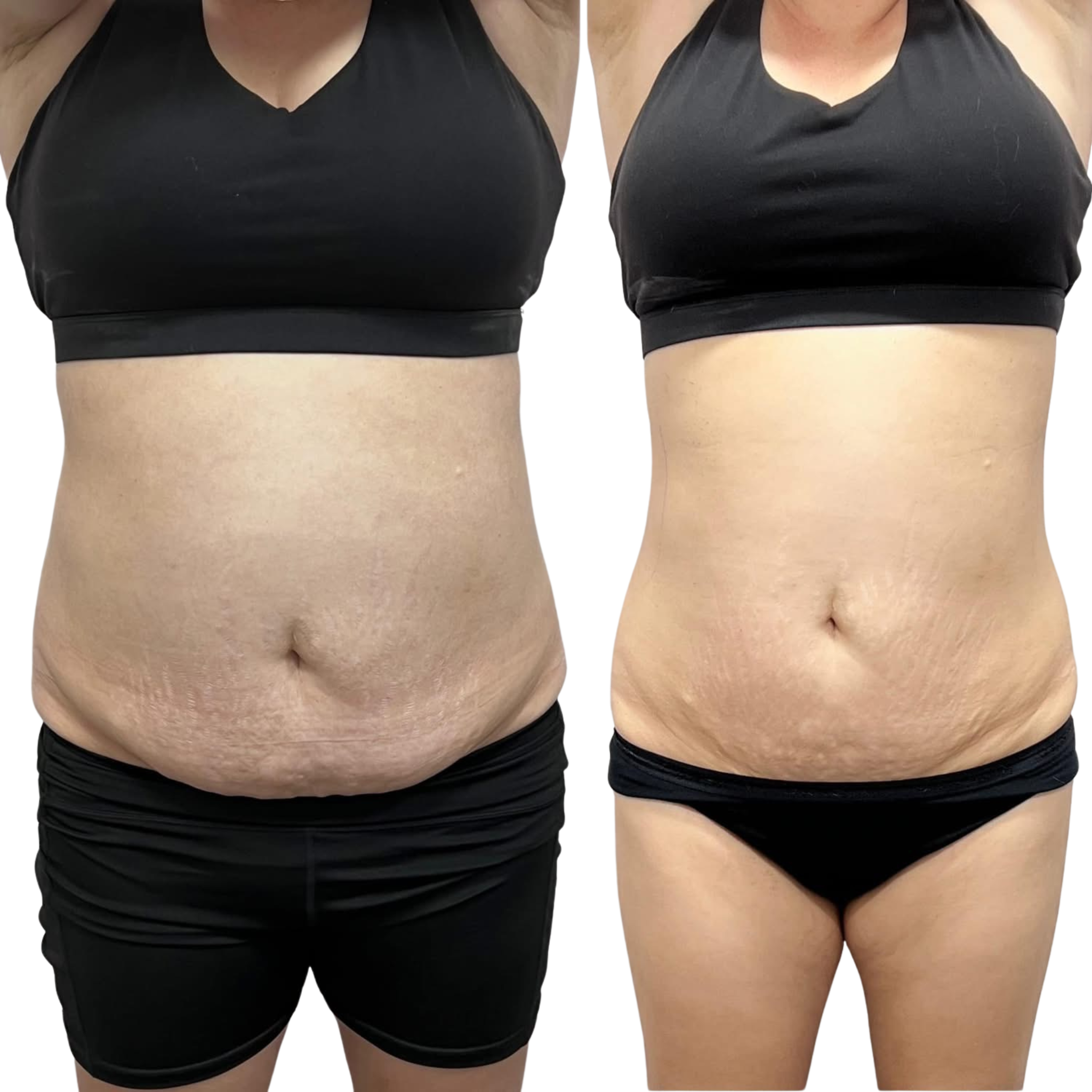 Compare of a woman's midsection before and after weight loss, showing difference in body shape and skin appearance.