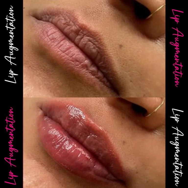 Close-up of lips before and after lip augmentation, showing smoother and fuller lips in the after image.