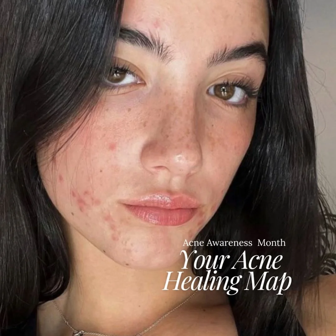June is Acne Awareness Month 🤍

Acne can feel exhausting... trying every product, hiding your skin and feeling frustrated when nothing seems to work
The truth is, acne is so much more than skincare alone.
Stress, hormones, diet, lifestyle and inflam