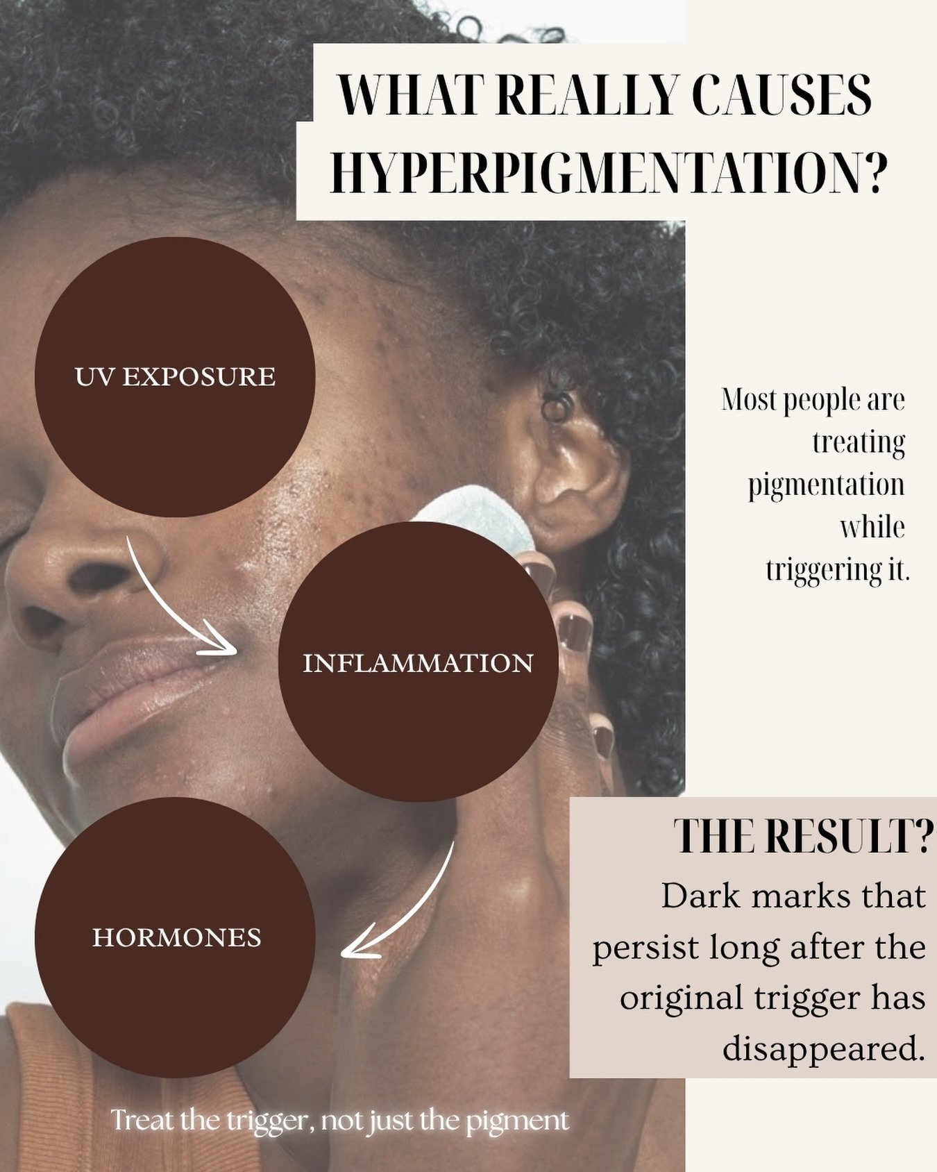 If you&rsquo;re struggling with hyperpigmentation, dark spots, or melasma, treating the pigment alone may not be enough.

Most pigmentation starts with a trigger.

☀️ UV exposure
🔥 Inflammation from acne, irritation, or over-exfoliation
🧬 Hormonal 