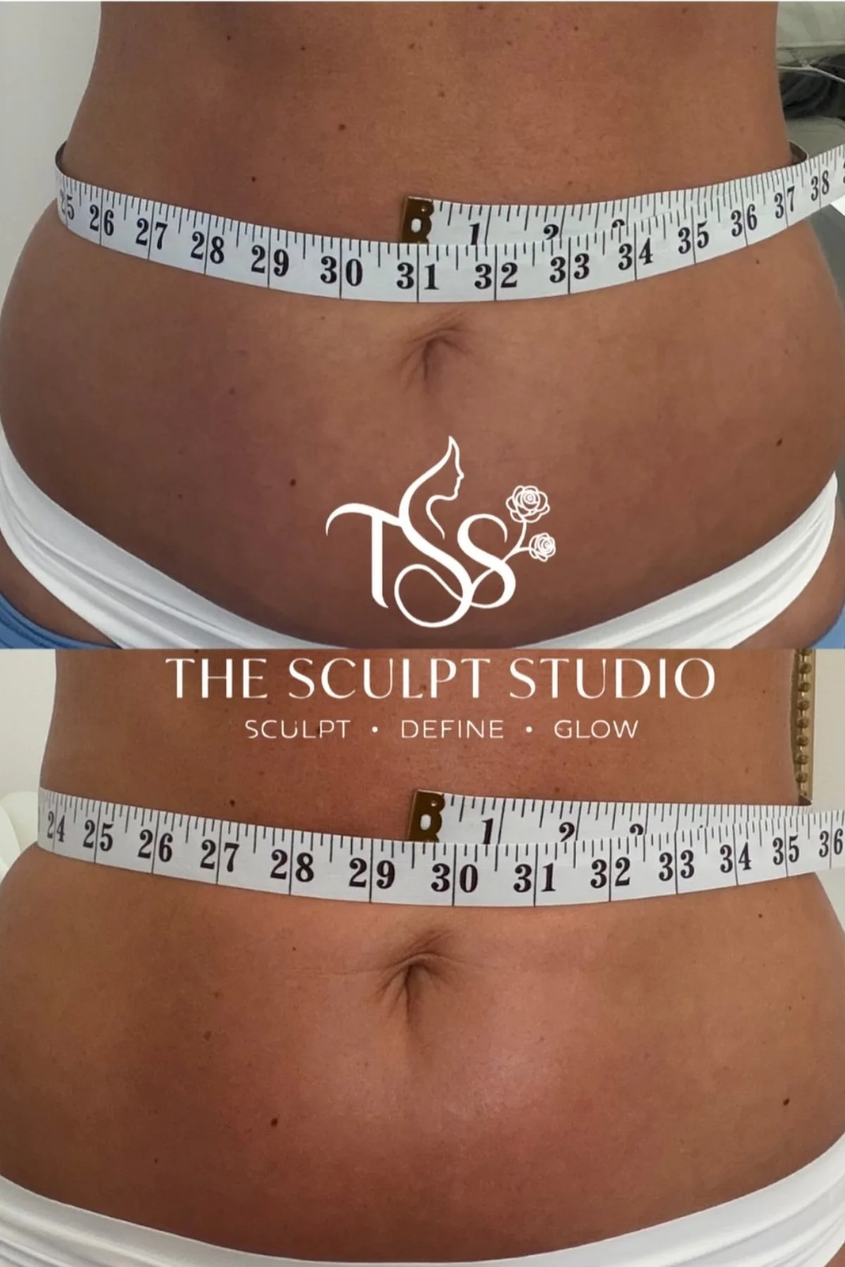 Before and after body contouring results showing waist measurement changes