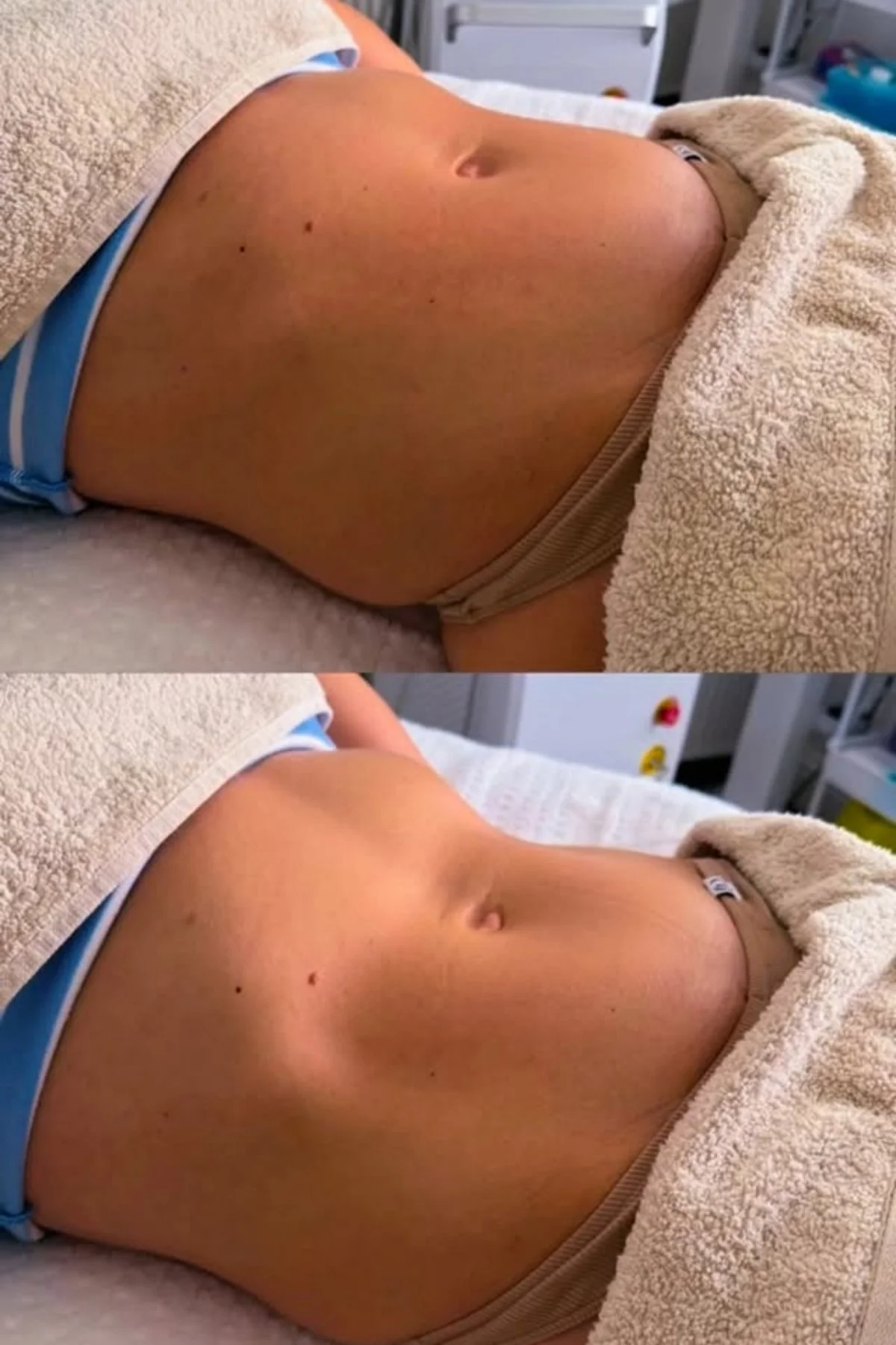Before and after stomach sculpting treatment results