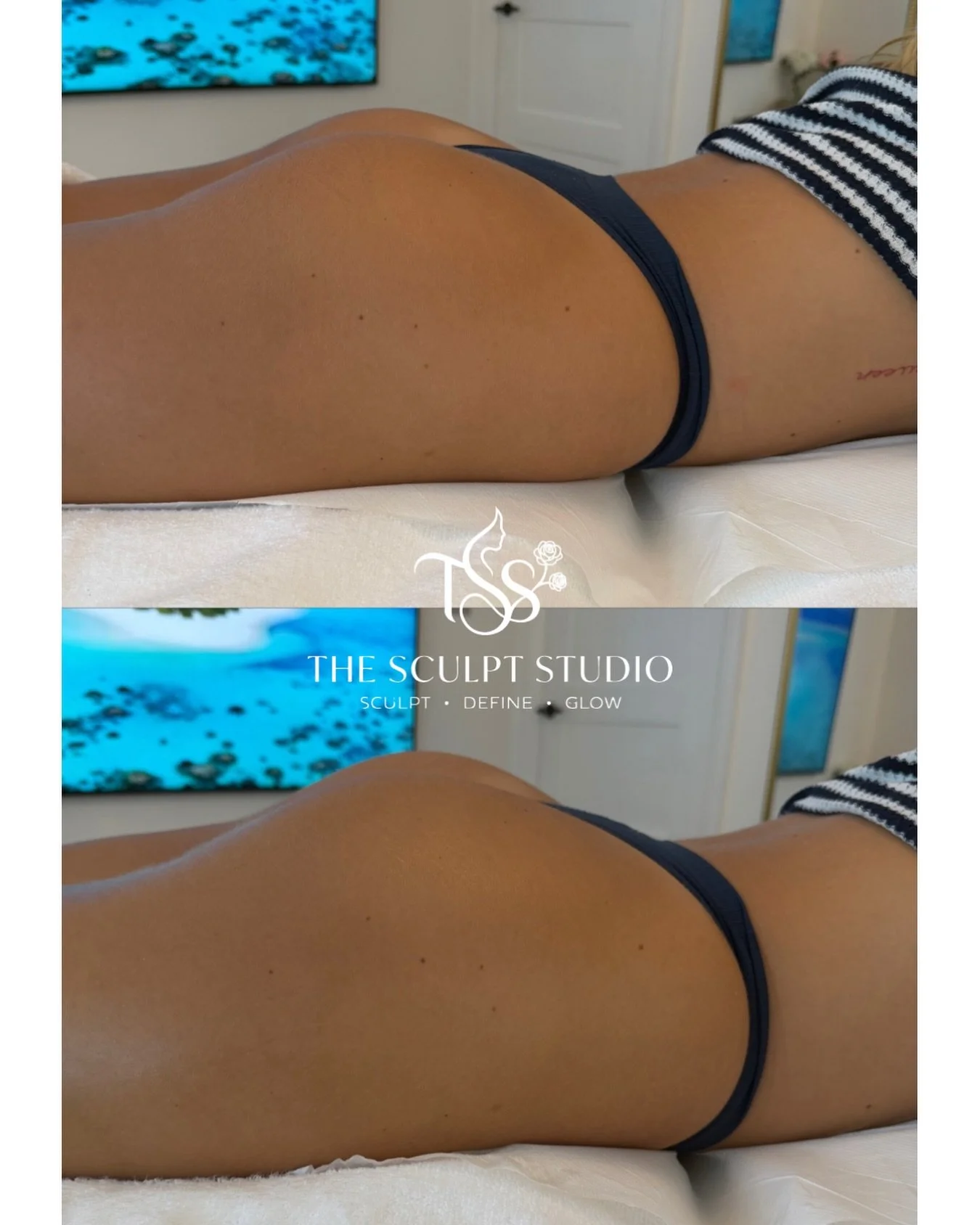 🍑 SCULPTED. LIFTED. DEFINED.

Just look at that difference after our first Bum Lift Body Contouring Treatment 😍

This treatment is designed to help:
✨ Sculpt &amp; contour
✨ Improve the appearance of cellulite
✨ Tighten &amp; firm the skin
✨ Enhanc