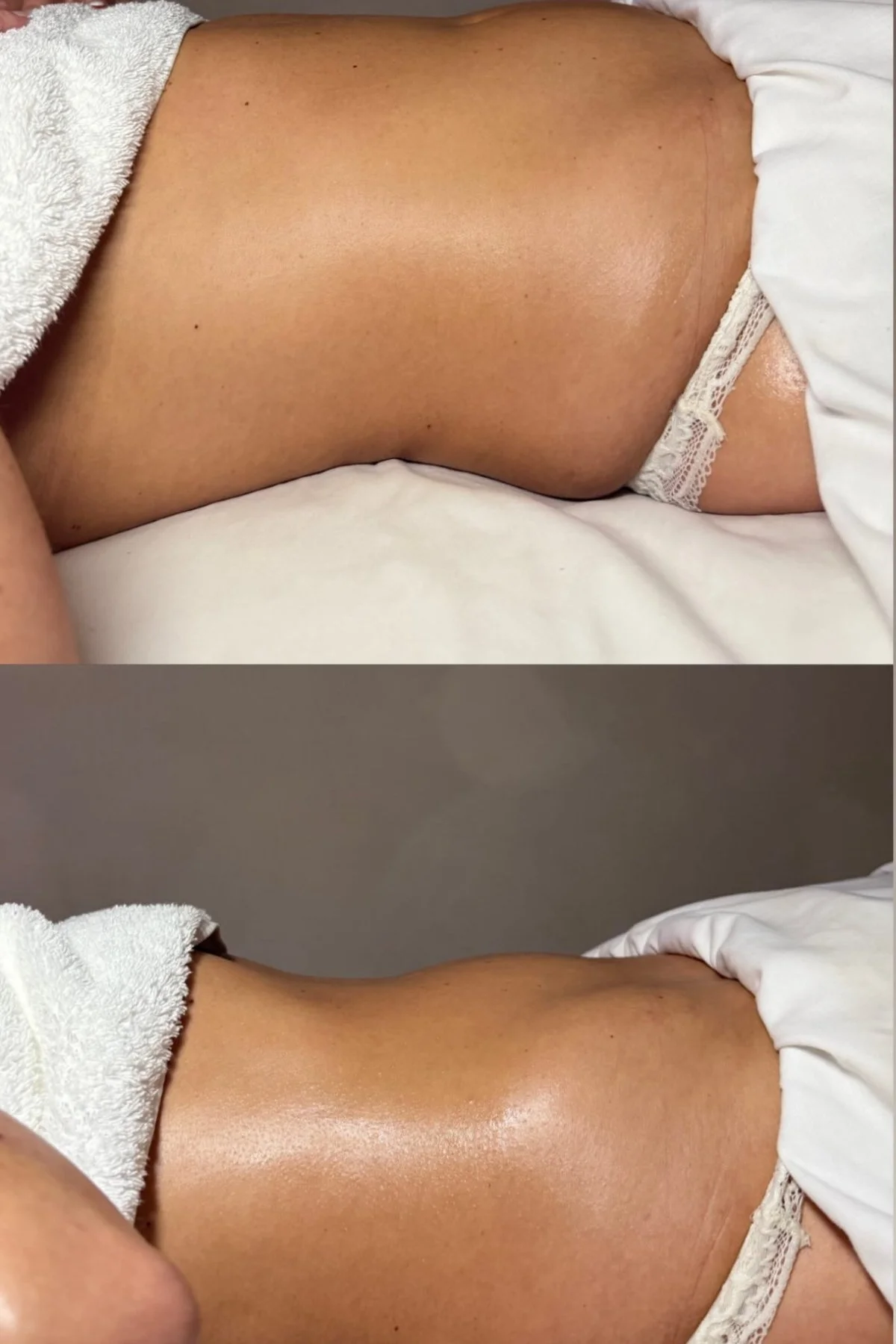 Before and after body contouring results showing improved waist definition