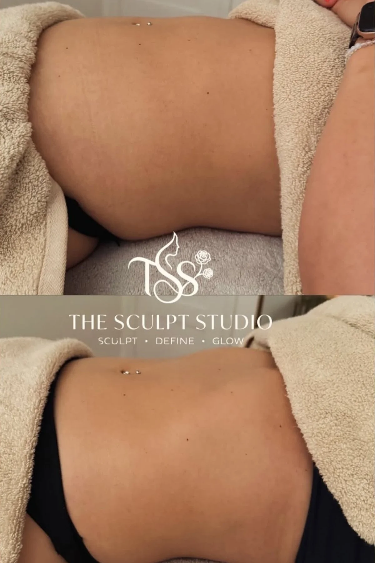 Before and after stomach body contouring treatment results