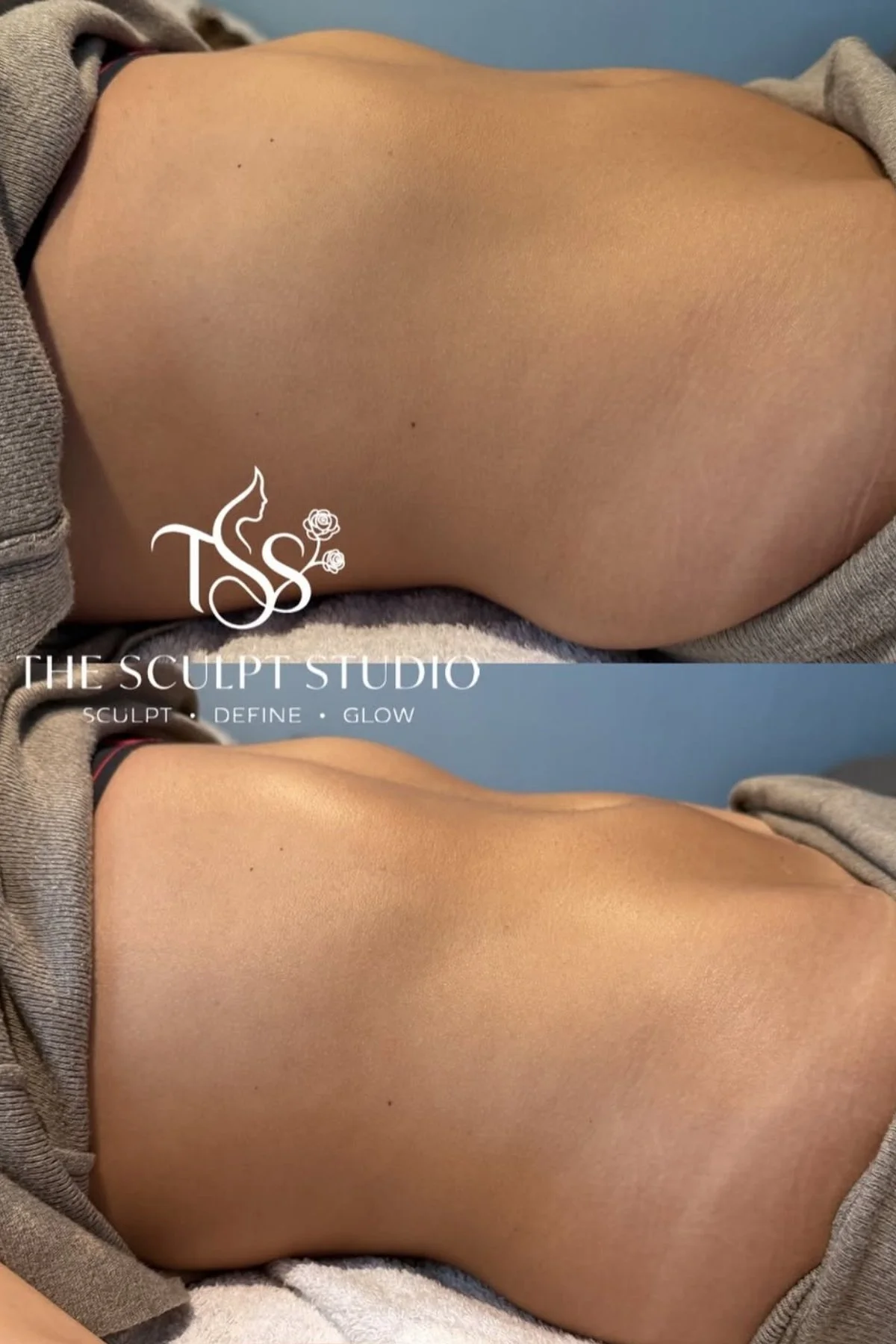 Before and after body contouring results showing improved stomach definition
