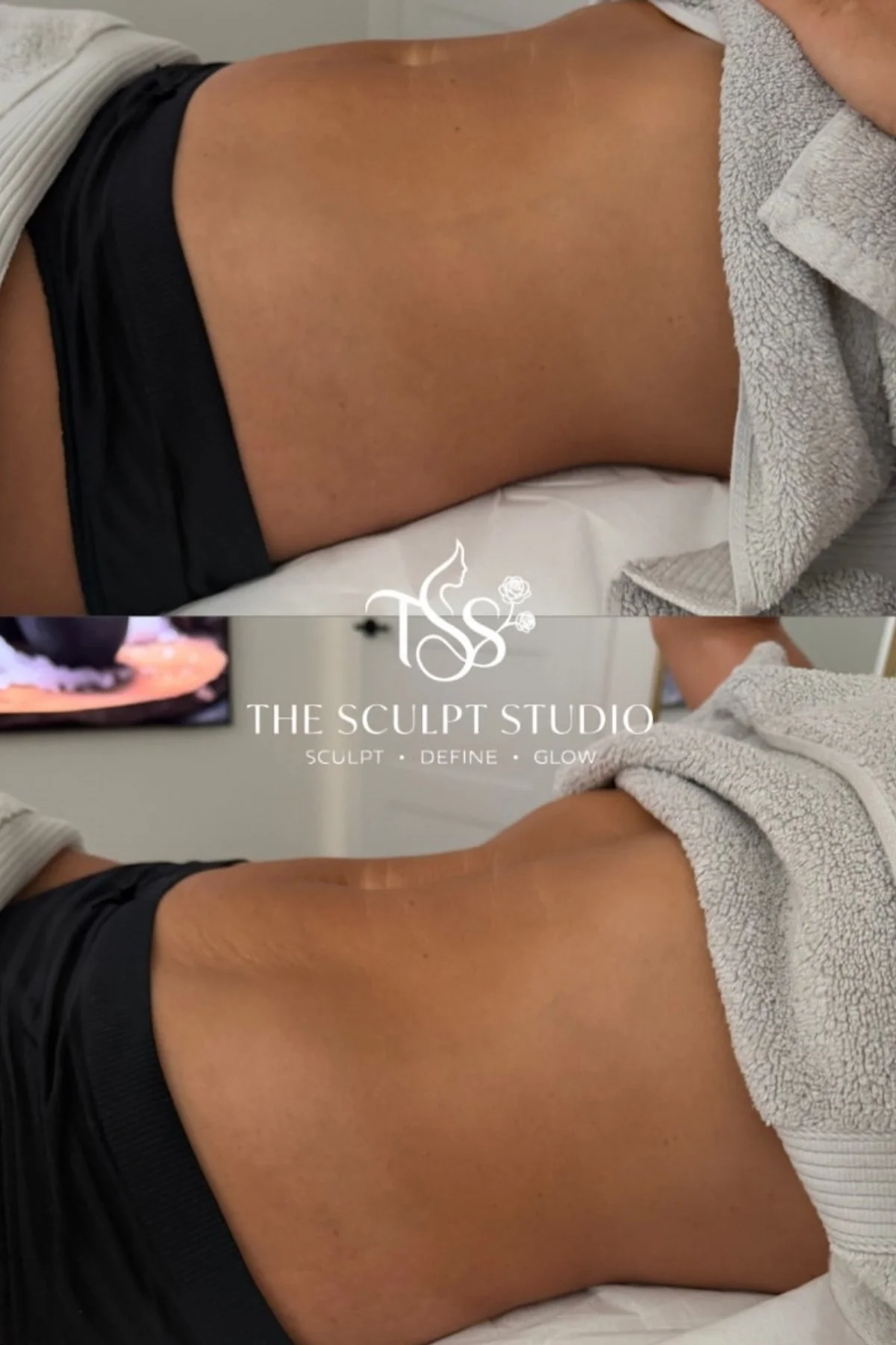 Before and after body contouring results showing a more defined waist and stomach