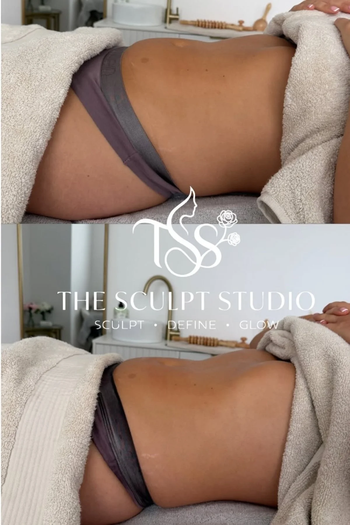 Before and after stomach sculpting results at The Sculpt Studio