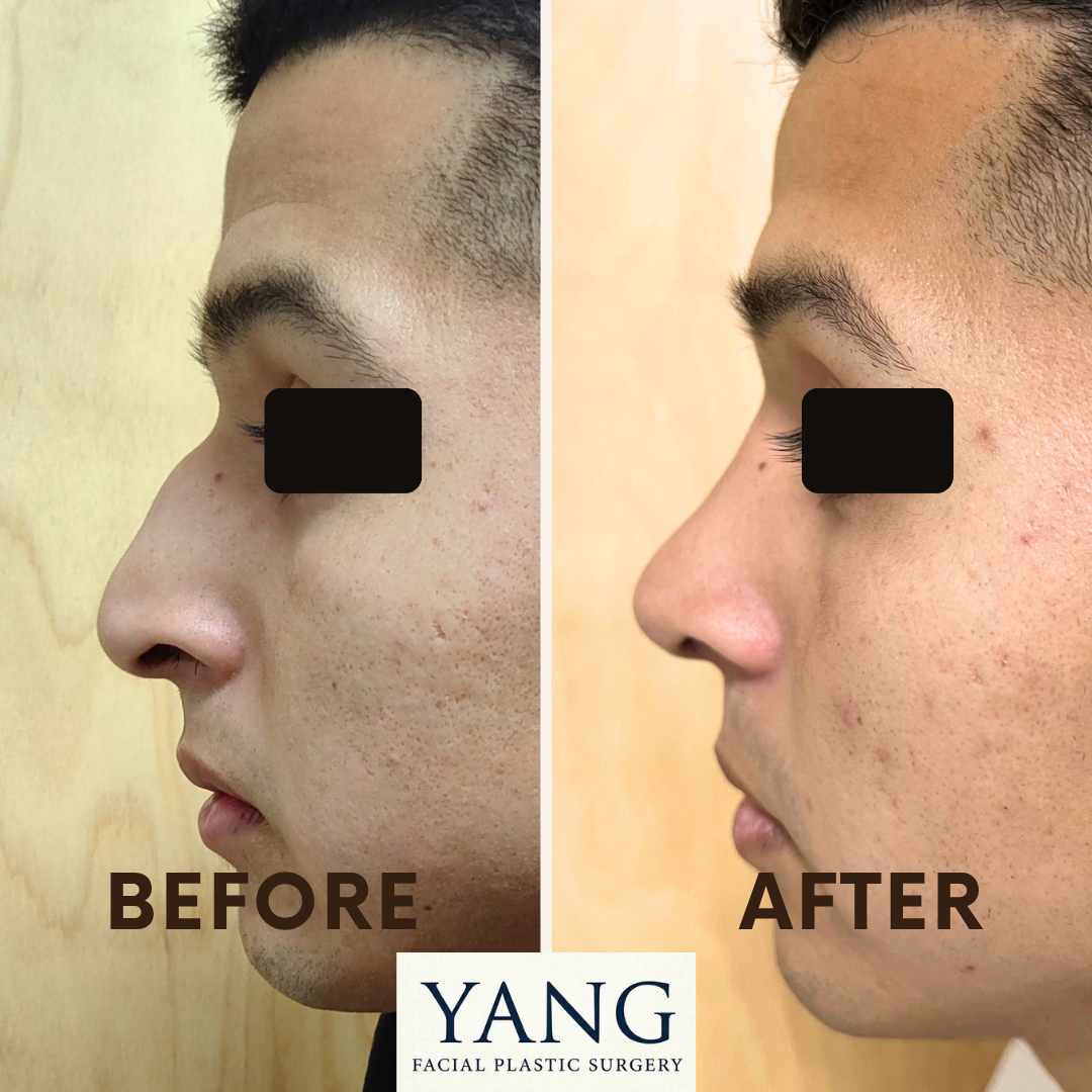 RHINOPLASTY Yang Facial Plastic Surgery | San Jose, CA