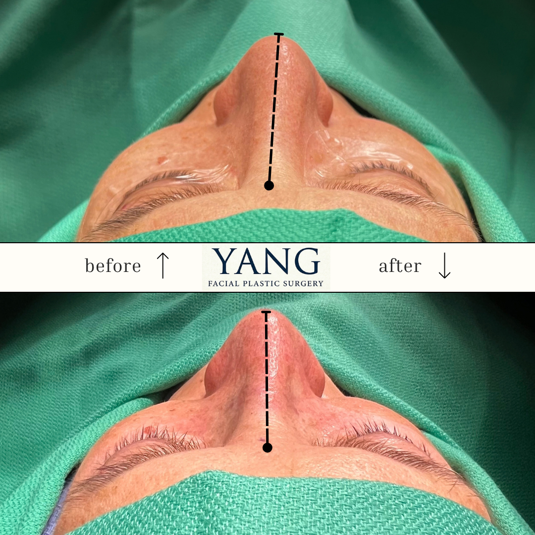 RHINOPLASTY Yang Facial Plastic Surgery | San Jose, CA