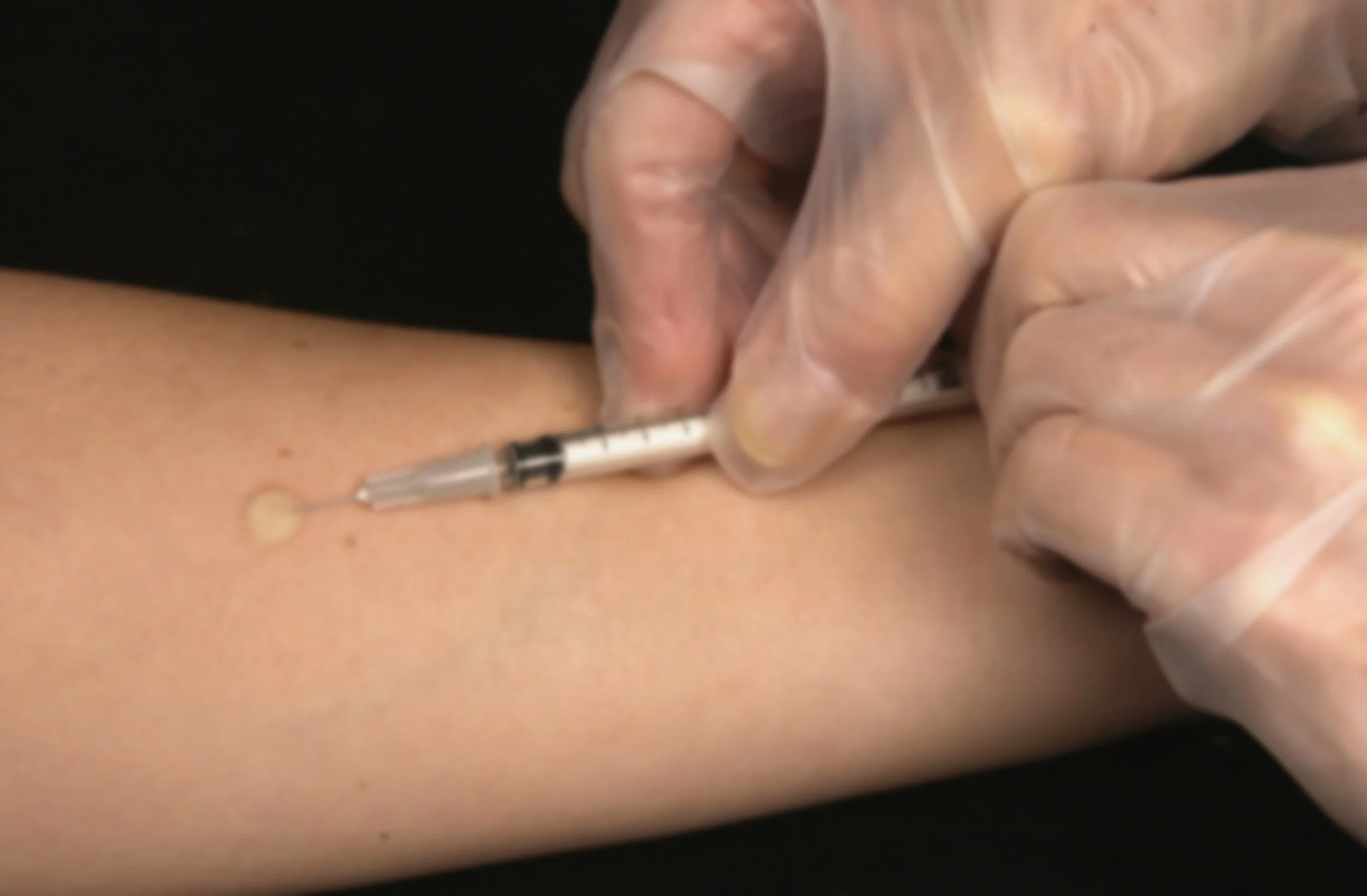 Tuberculosis (TB) 2 step skin testing near me in overland Park and Kansas City