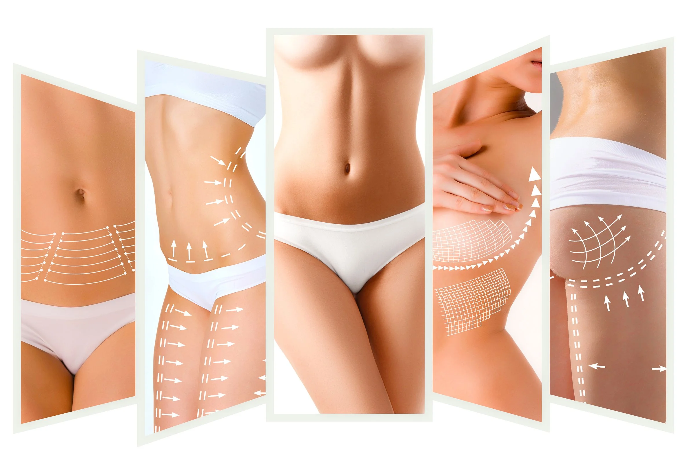 Image illustrant la silhouette féminine mettant en valeur le ventre et les côtés, avec des dessins de flèches et de lignes pour symboliser la liposuccion ou la sculpture du corps.