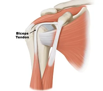 Bicep Tendinitis: A Game Changer For Overhead Athletes and How You Can Prevent This From Sidelining You!