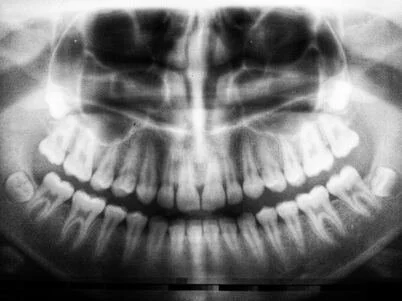 X-ray image of a person's teeth and jaw.