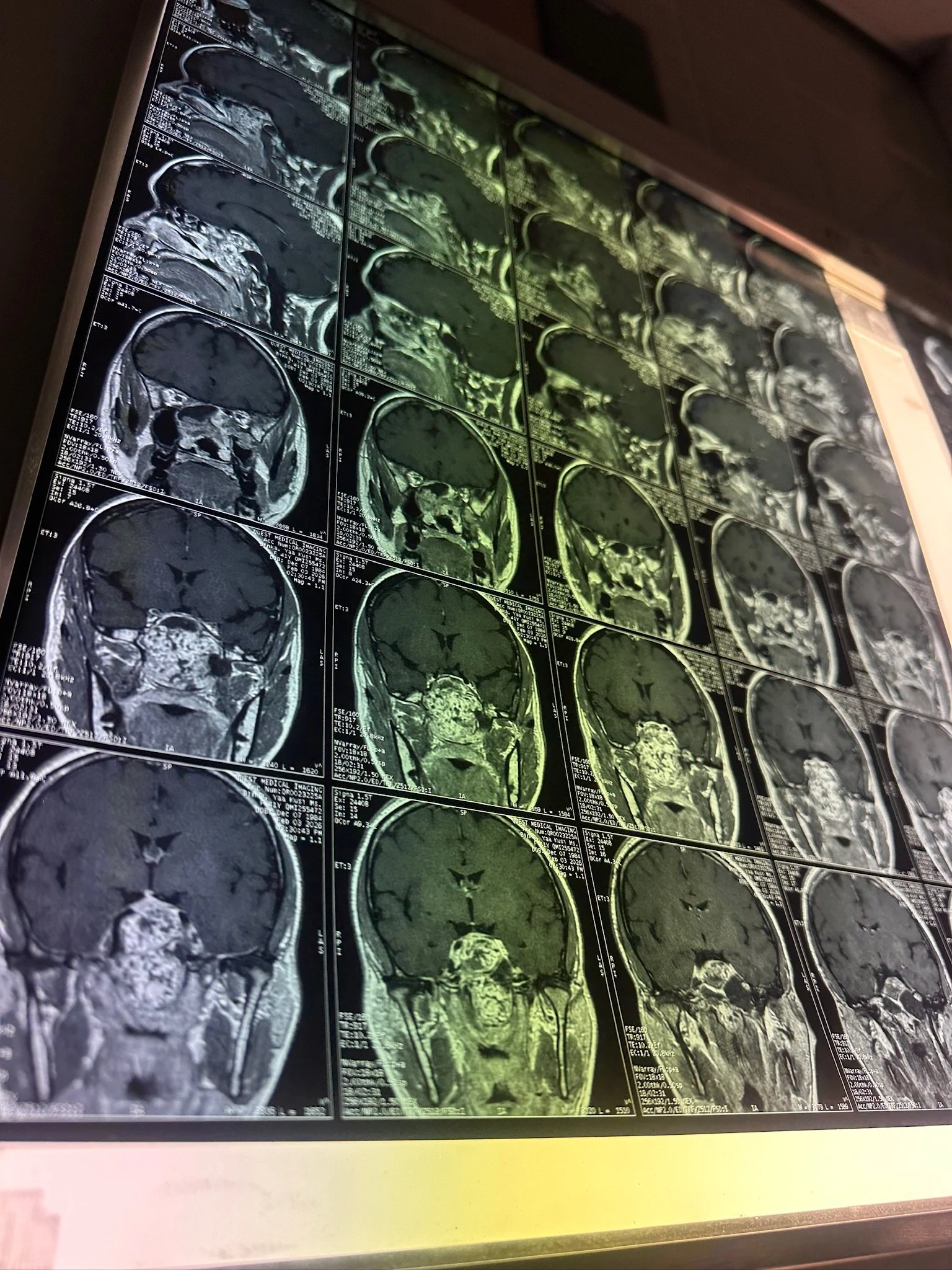 Multiple MRI scans of a human brain displayed on a screen in a medical setting.