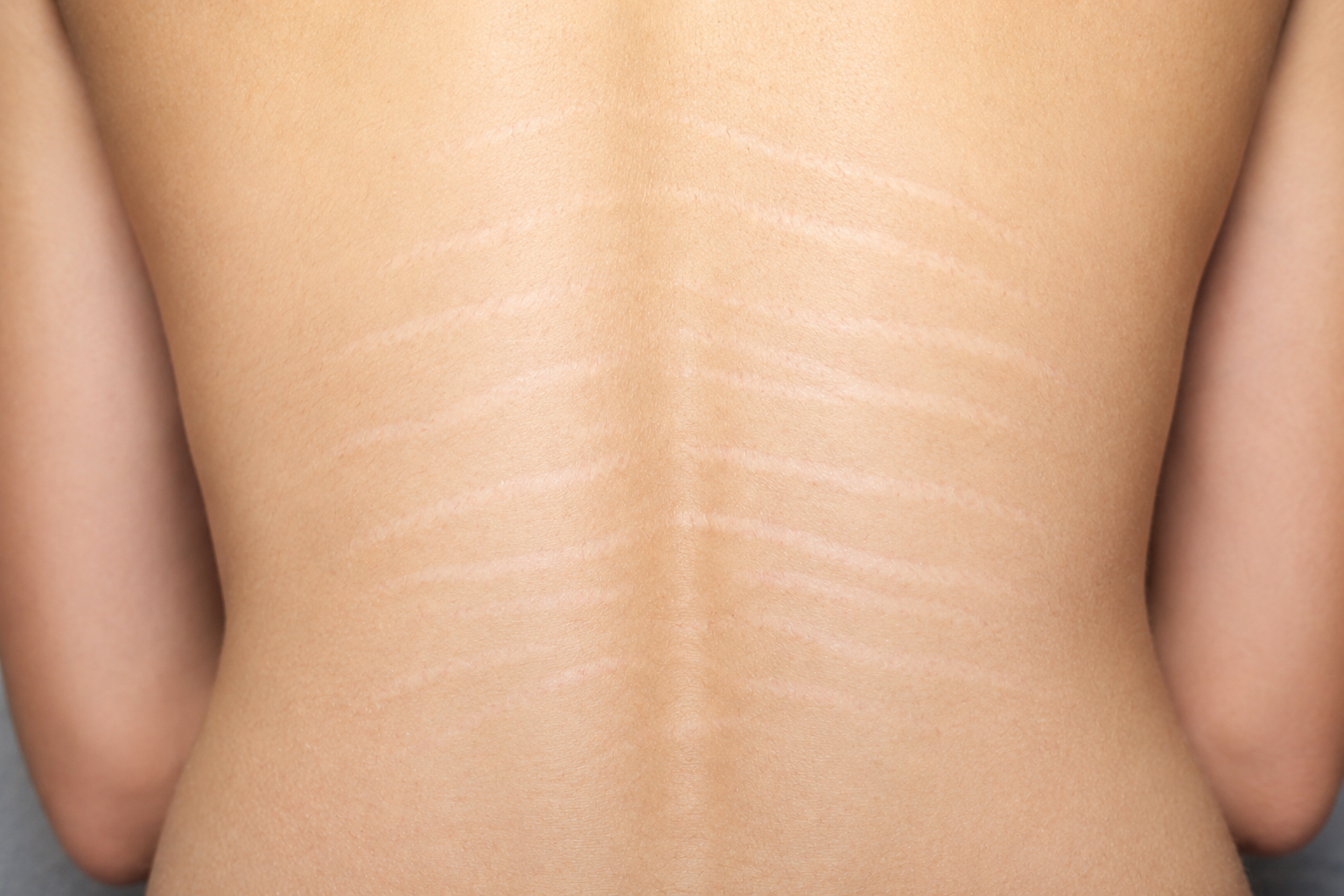 Stretch Mark Personalized Consultation Service