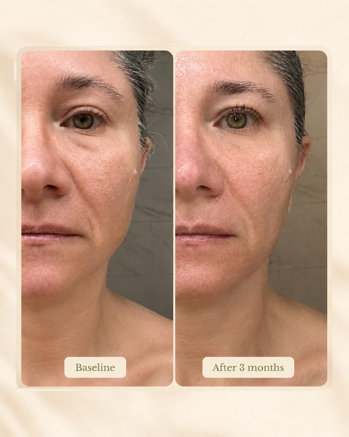 Comparison of a woman's face before and after 3 months of skincare treatment, showing improved skin texture and reduced fine lines.