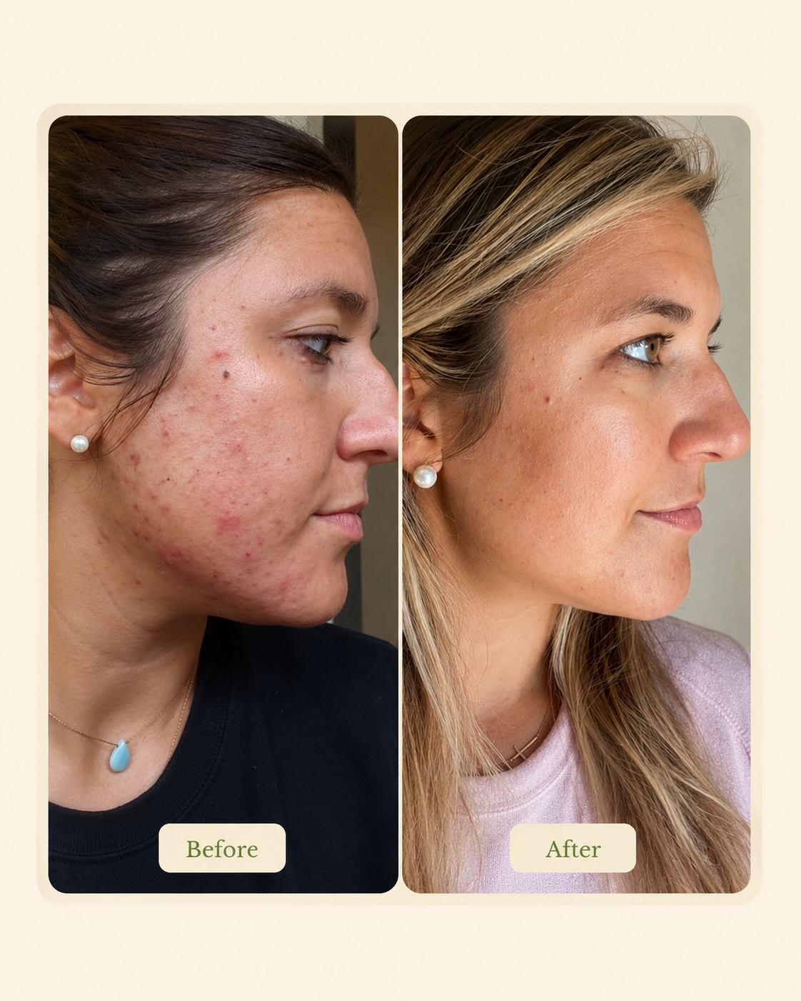 Before-and-after facial skin treatment comparison at Skin Intrinsic.