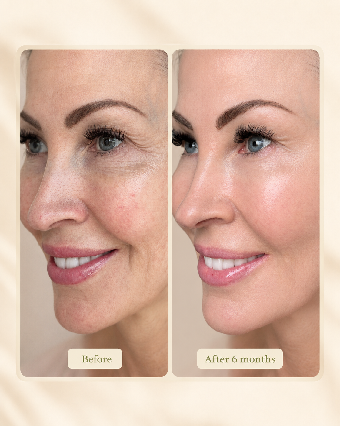 Before-and-after comparison showing skin appearance over six months of professional skin care.