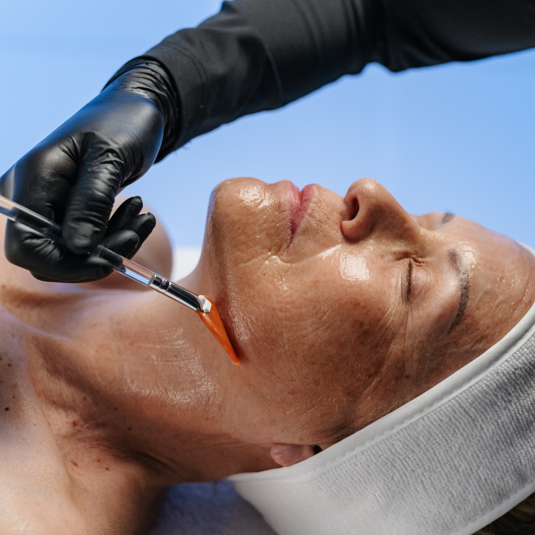 Clinical Peels treatment at Skin Intrinsic in Yandina, Sunshine Coast.