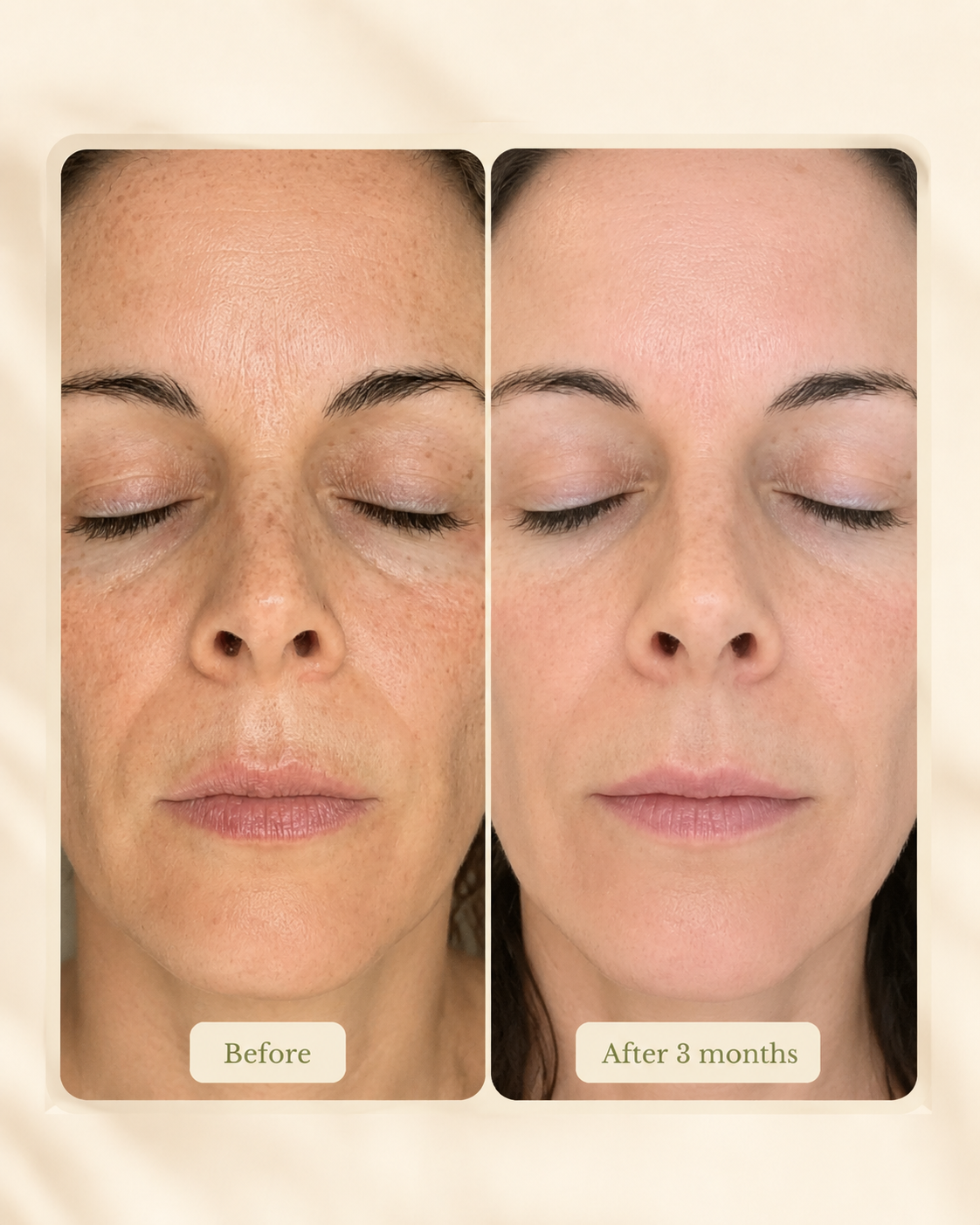 Side-by-side comparison of a woman's face before and after 3 months of skincare treatment, showing improvements in skin texture and tone.
