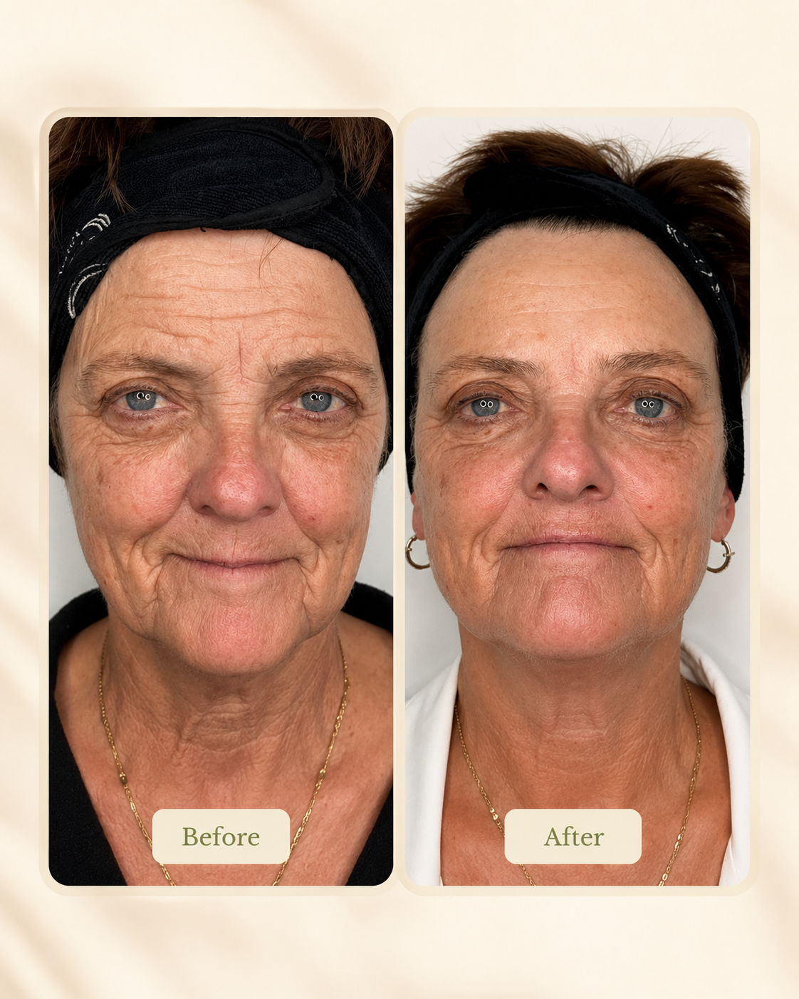 Before-and-after facial skin treatment comparison showing changes in skin appearance.