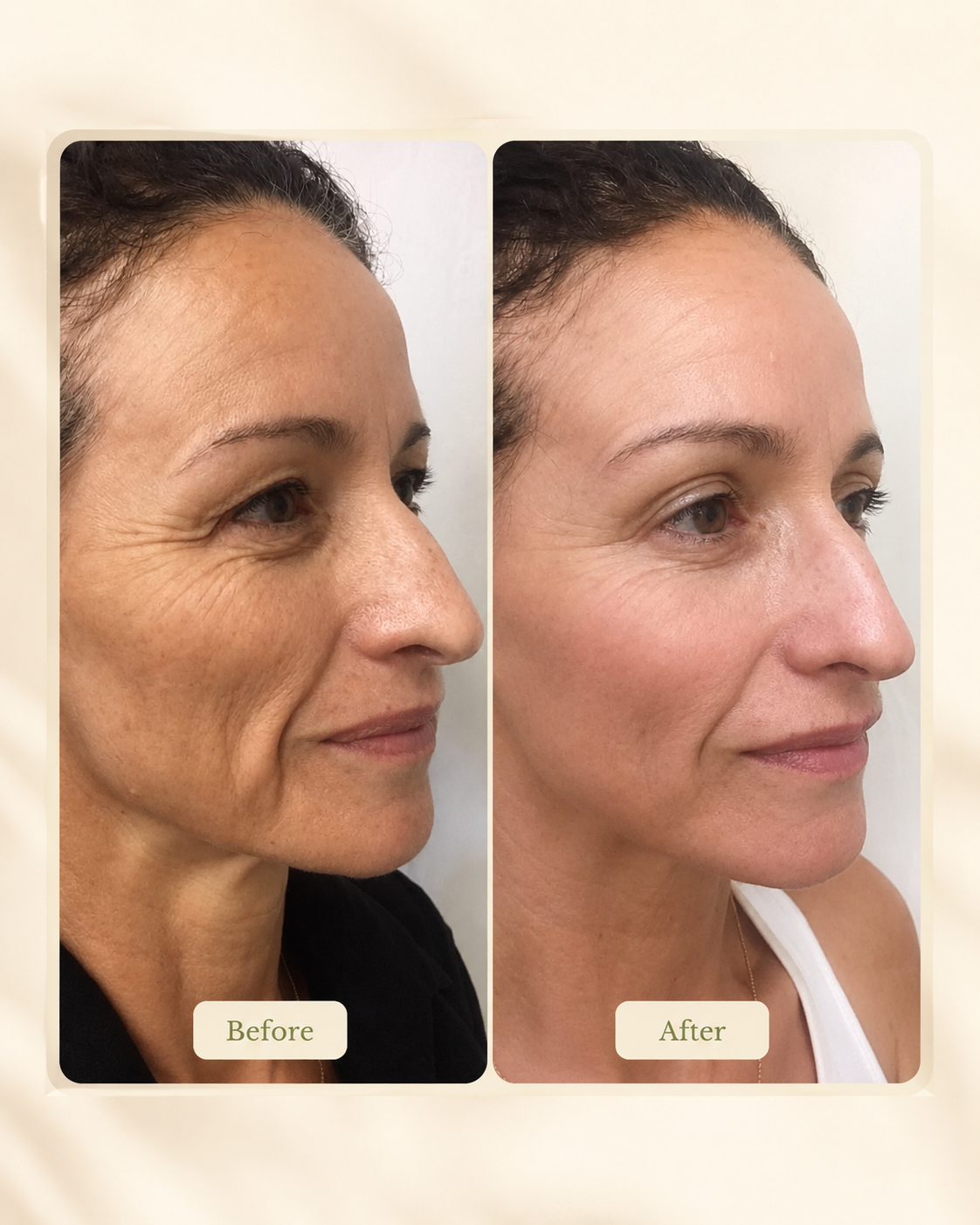 Before-and-after skin treatment comparison showing changes in the appearance of mature skin.