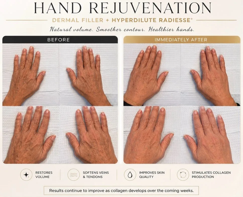 ✨ BEFORE &amp; IMMEDIATELY AFTER ✨

Hand Rejuvenation

Our hands are one of the first areas to show signs of aging. As collagen and volume naturally decline, veins, tendons, and fine lines become more noticeable.

For this patient, we performed a cus