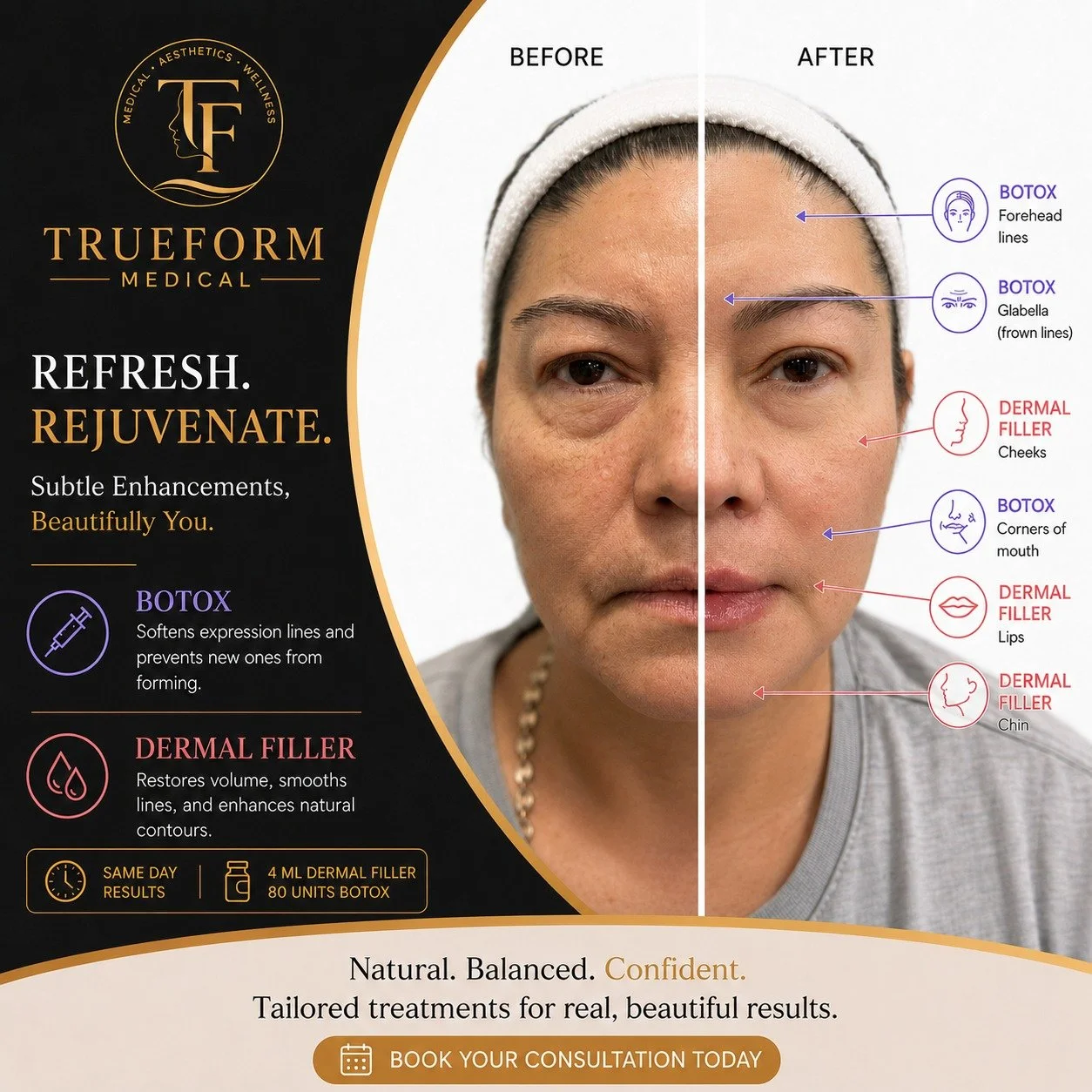✨ Subtle changes. Beautiful confidence.
This transformation was achieved with 4 mL of dermal filler and 80 units of Botox, carefully customized to restore balance, soften expression lines, and enhance natural facial contours&mdash;without looking ove