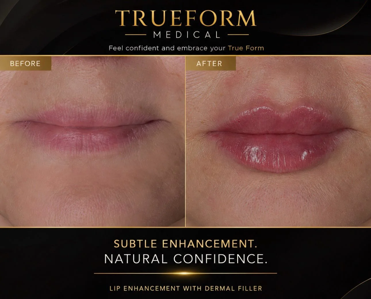 Your lips. Your confidence. Your True Form. #TrueFormMedical #LipEnhancement #NaturalLipFiller #MedicalAesthetics Mississauga