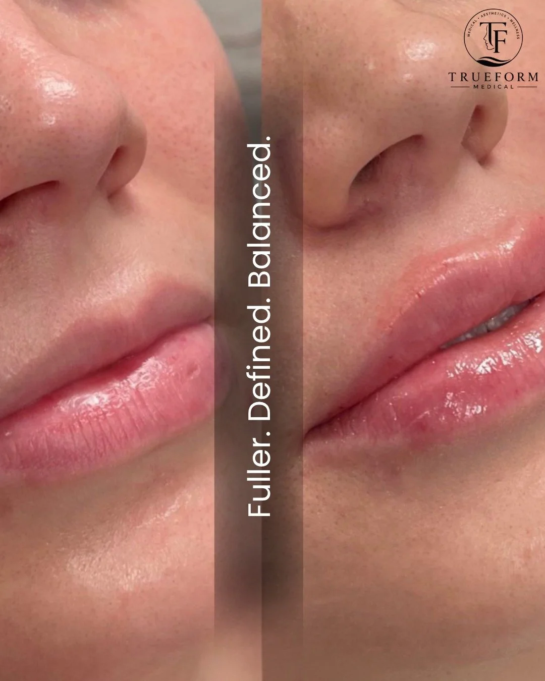 The difference is in the details.  Enhanced volume, improved definition, and beautifully balanced proportions.
#TrueFormMedical #LipFiller #MedicalAesthetics