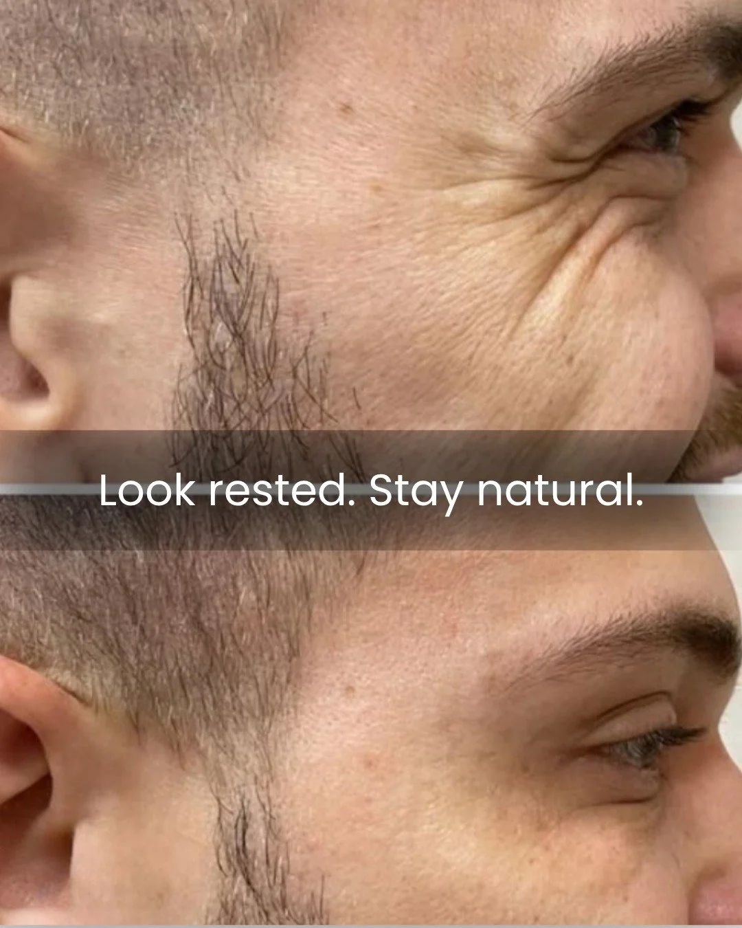 Looking refreshed isn&rsquo;t just for her. Subtle, strategic treatment can soften expression lines while maintaining a natural, masculine look.
#BotoxForMen #TrueFormMedical #MedicalAesthetics