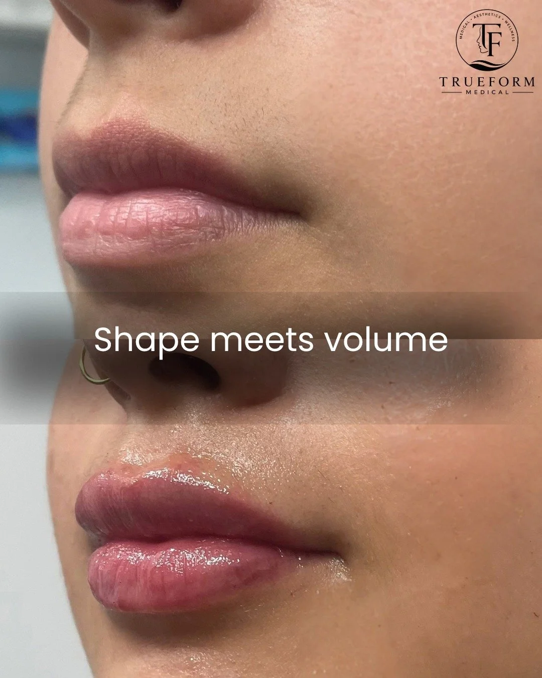 Ready for your own lip refresh? Your TrueForm transformation starts with us! #TrueFormMedical #LipFillerMississauga #LipEnhancement #MississaugaAesthetics