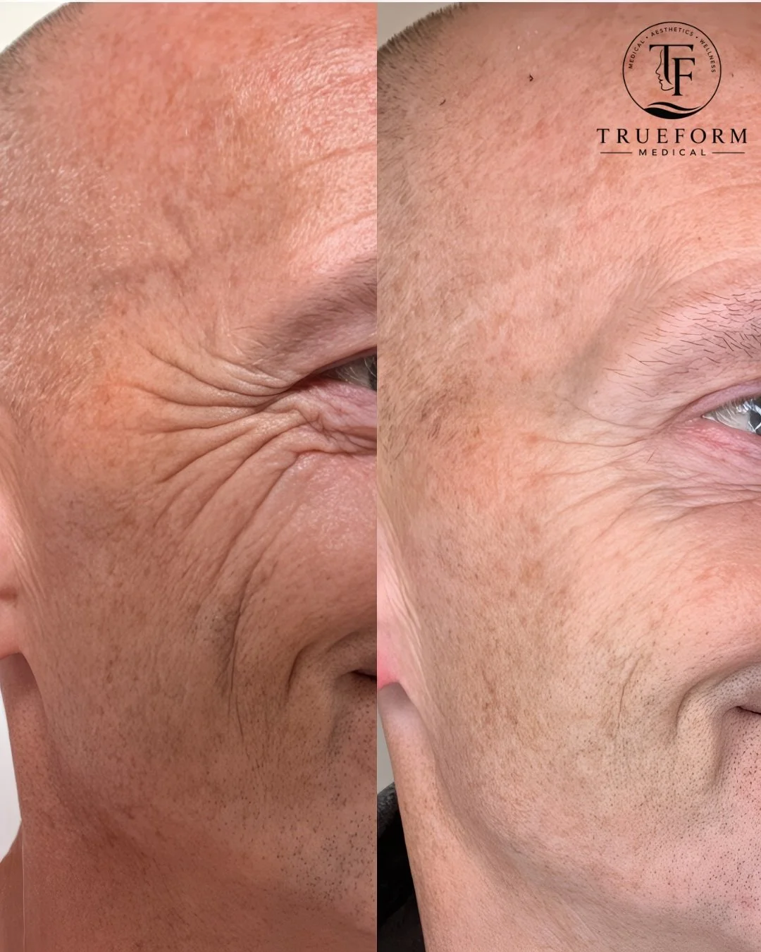 Full-face rejuvenation with natural-looking results.
These photos were taken 2 months apart. The result was achieved using full-face Botox + just 1 syringe of Radiesse to soften dynamic lines, improve facial support, and create a smoother, refreshed 
