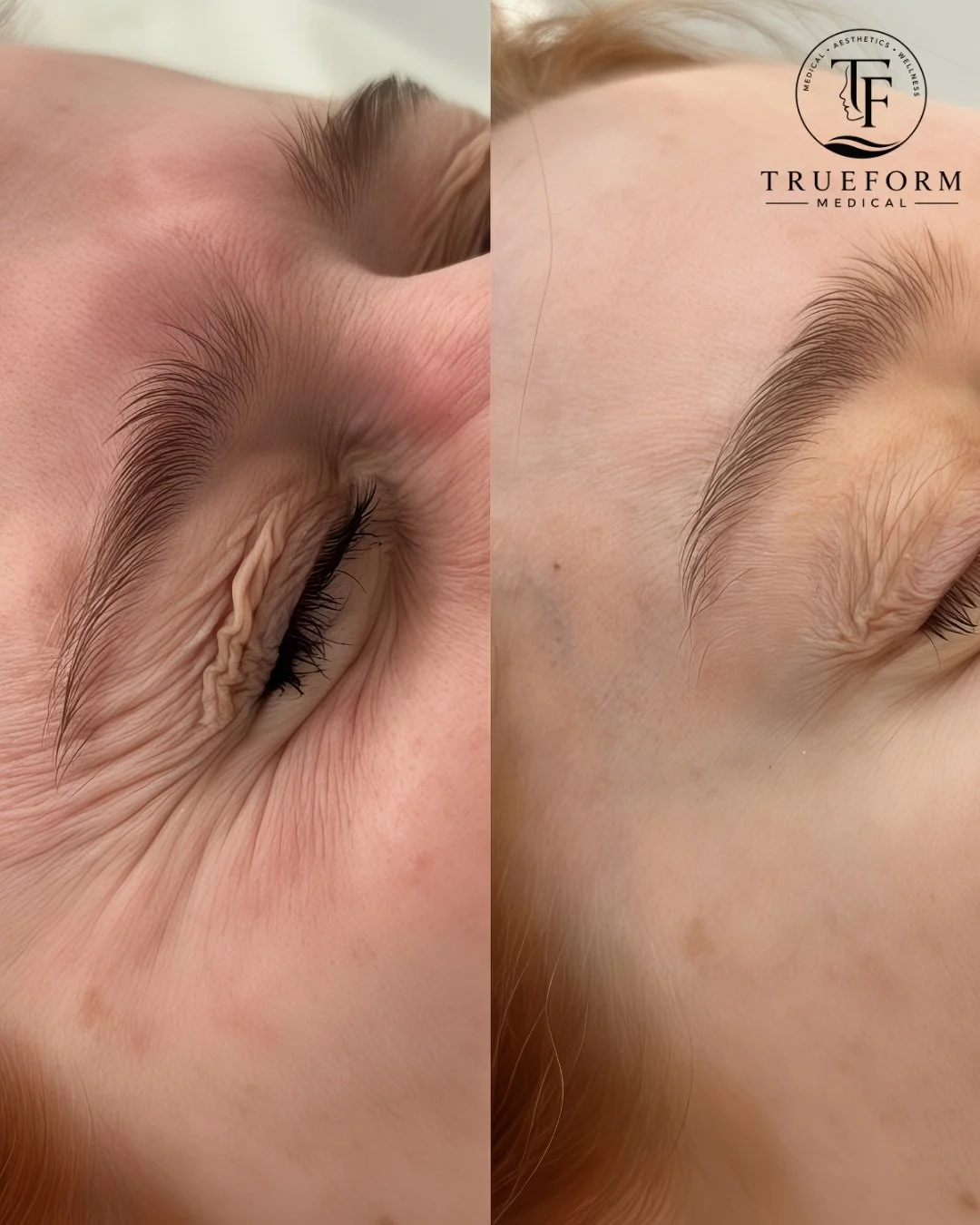 Smoother lines. Refreshed look. Still you. ✨ Enjoy 20% off Botox &amp; Dysport treatments.

#TrueFormMedical #BotoxMississauga #Dysport #Botox