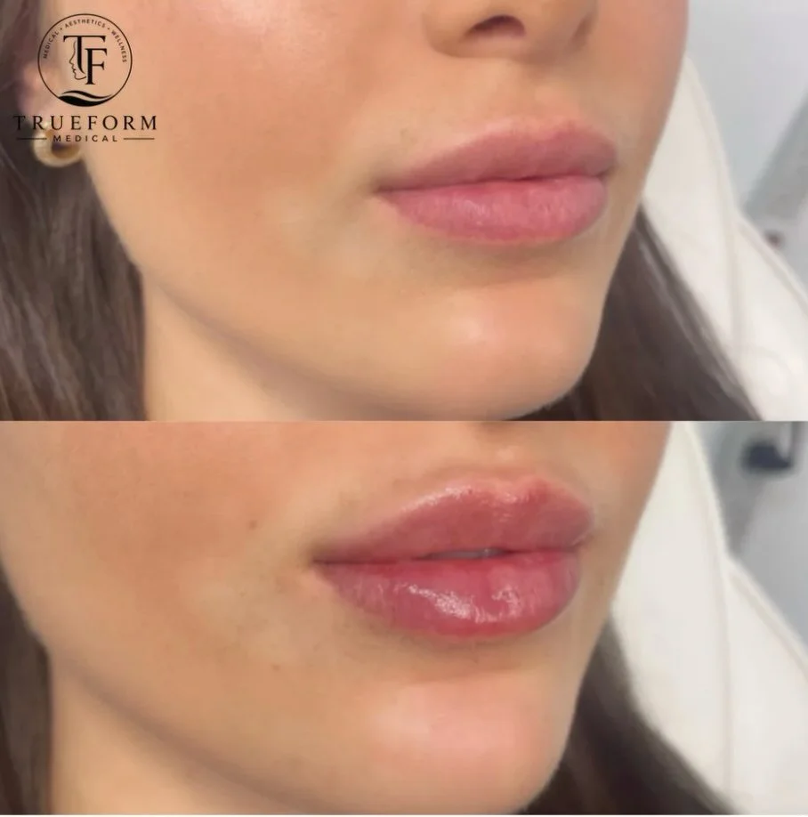 💋 Subtle volume. Defined shape. Still YOU.

Because the best lip filler shouldn&rsquo;t scream &ldquo;filler.&rdquo; ✨

📍 TrueForm Medical | Mississauga
📲 Book your consultation

#LipFiller #NaturalLips #LipEnhancement #MississaugaAesthetics