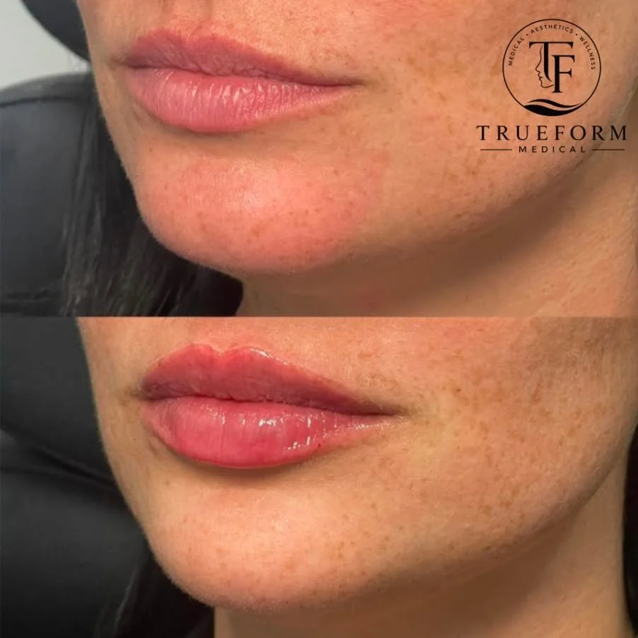 Subtle enhancement. defined lips.

A little volume, enhanced shape, and natural-looking results that complement your features.

Because the best results still look like YOU. 🤍

📍 TrueForm Medical | Mississauga
📲 Book your consultation today!

#Tru