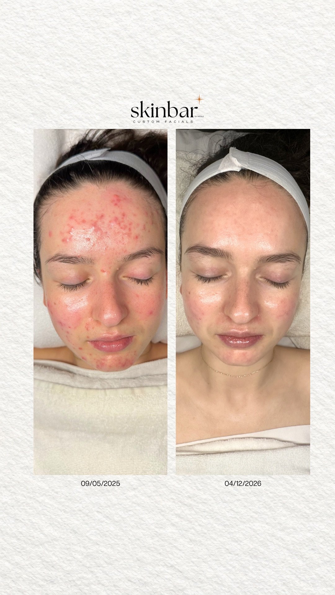 Side-by-side comparison of a woman's face before and after skincare treatment; the left shows acne and redness, the right shows clear skin.