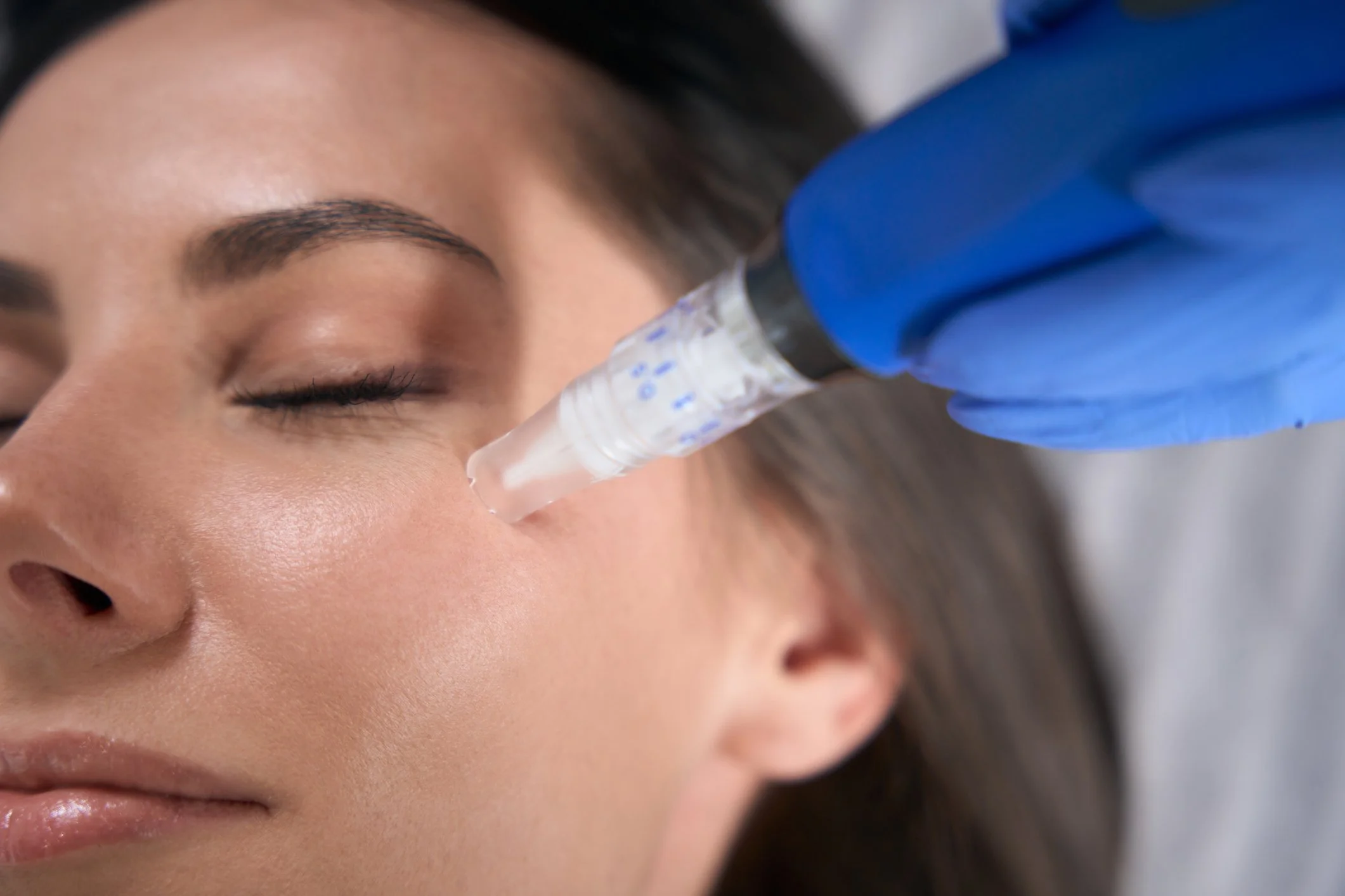 Medspa in Fremont, CA, 94555 Microneedling Near Me
