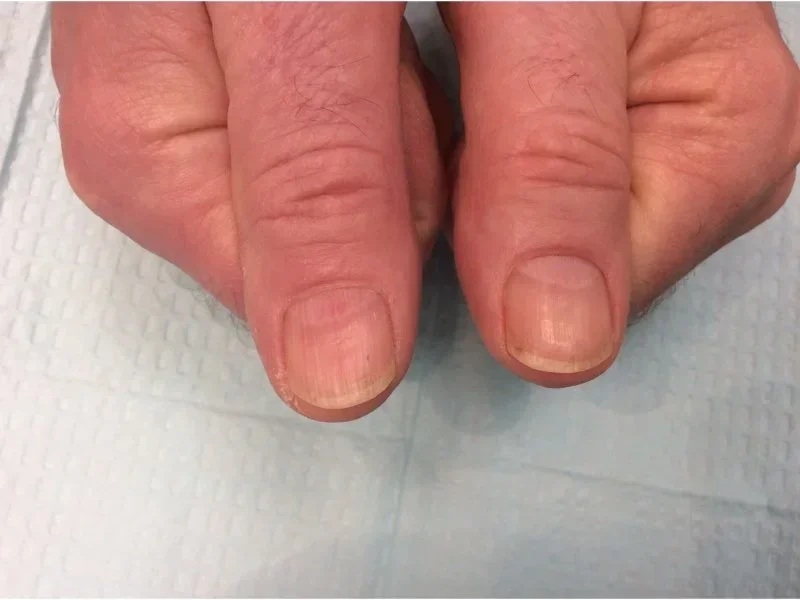 Post-treatment