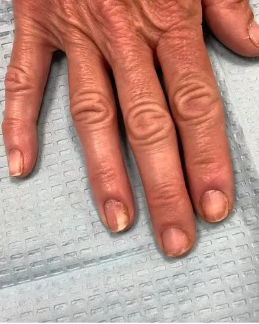 Occupational Induced Nail Disorders