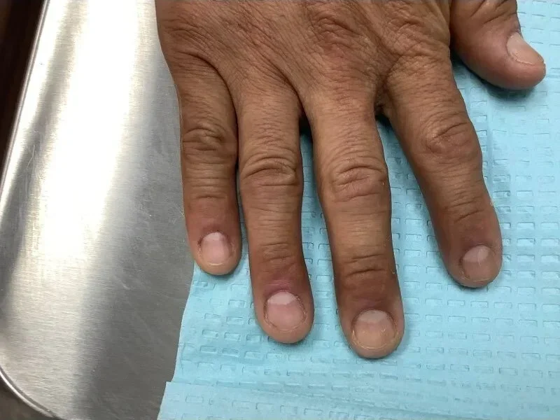 Post-treatment