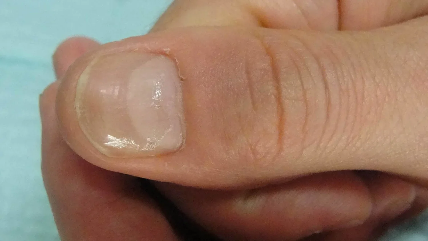 Post-treatment