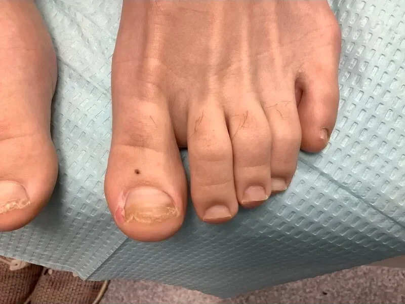 Post-treatment
