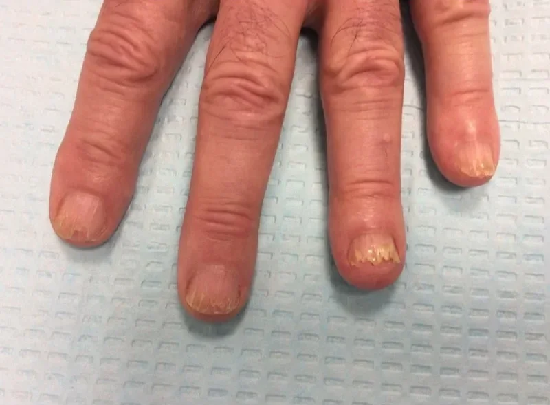 Pre-treatment