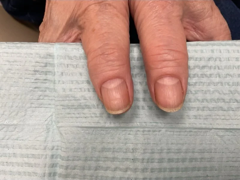Post-treatment