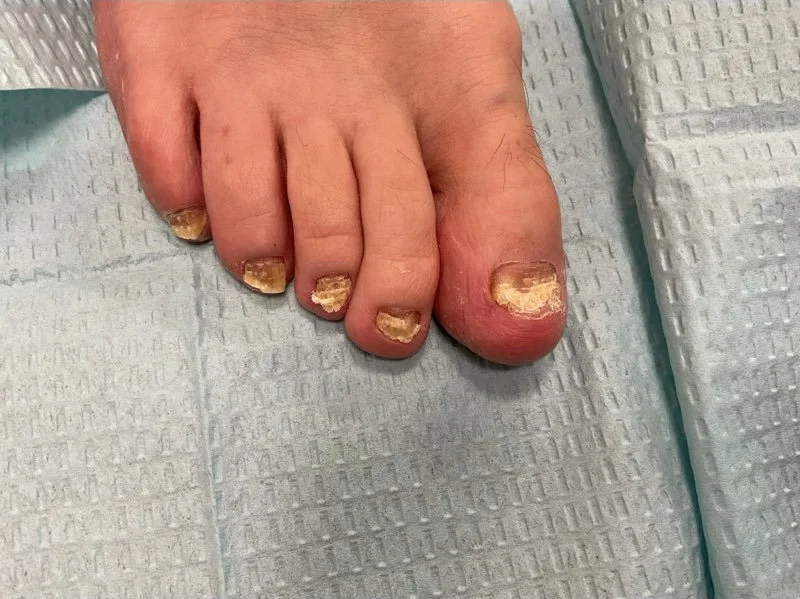 Pre-treatment